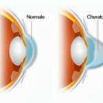 cheratocono1