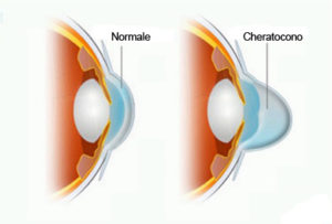 cheratocono1