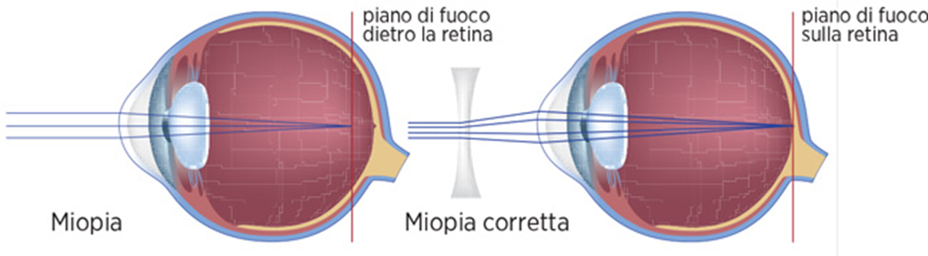 chirugia_laser_1