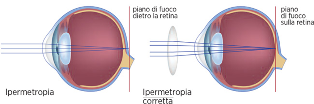 chirugia_laser_2