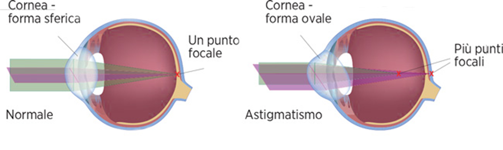 chirugia_laser_3